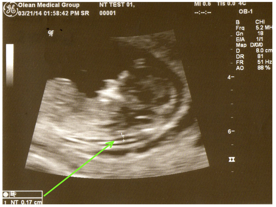 down syndrome 18 week ultrasound 4d